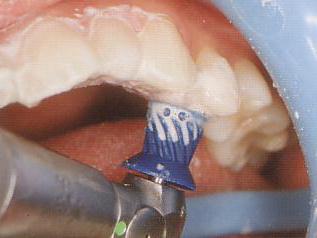 歯科衛生士による歯のクリーニング、ＰＭＴＣ